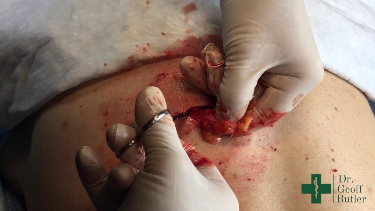 Removal of a Lipoma on the Back using a Blunt technique