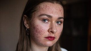 I'm Finally Happy To Show My Acne On Instagram | SHAKE MY BEAUTY