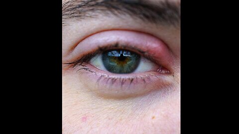 Quick Stye Relief: DIY Warm Compress Hack #StyeRemedy #EyeCare