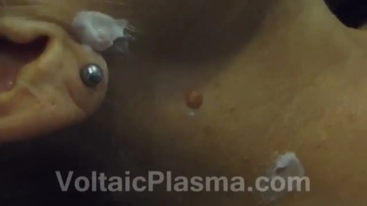 THE MOLE REMOVAL WITH ELECTRICAL ARCING