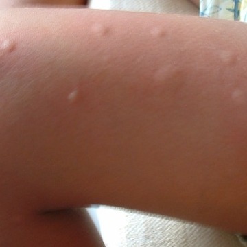 This Is Why You Are Always On Mosquito's Wish List For Bites