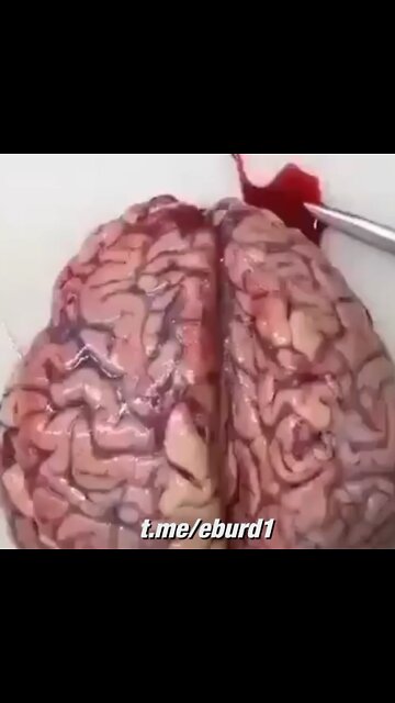 Sezierung des Gehirns eines gegen mRNA Covid-19 Geimpften