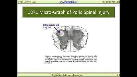 1871 Micro-Graph of Polio Spinal "Vascular" Injury - Byron Hyde, MD