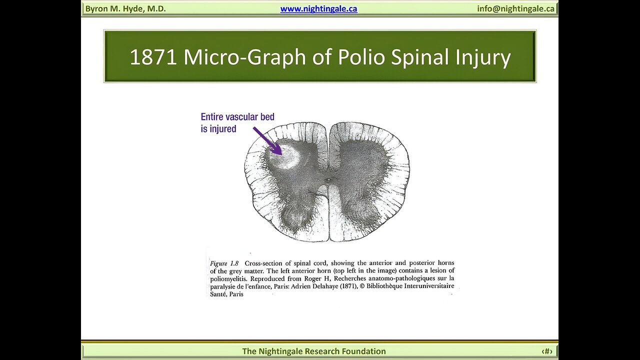 1871 Micro-Graph of Polio Spinal "Vascular" Injury - Byron Hyde, MD