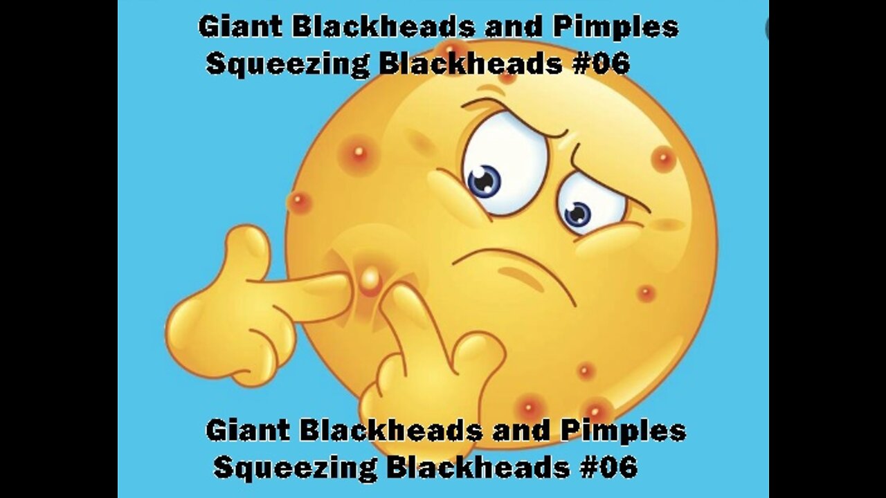 Giant Blackheads and Pimples Squeezing Blackheads #06