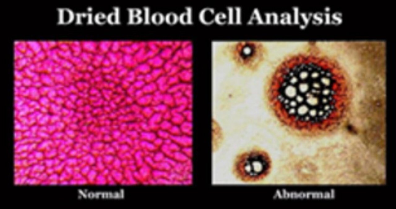 LINK - Scanning & Transmission Electron Microscopy Reveals Graphene Oxide in CoV-19 Vaccines