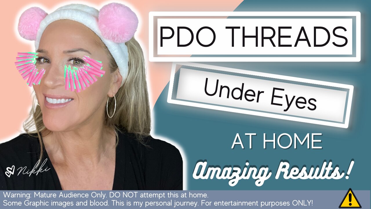 How To Get Rid Of Under Eye Wrinkles with PDO Threads!