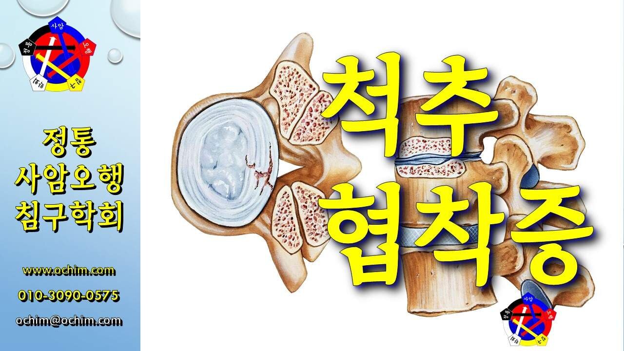 척추협착증 치료 방법 - 비과학적 양의학 178 - 사암침, 사암침법, 정통사암침