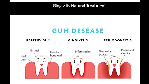 Gingivitis - Gum Inflammation & Infection - Natural Treatment