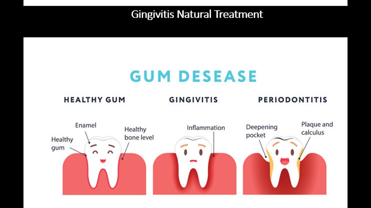 Gingivitis - Gum Inflammation & Infection - Natural Treatment