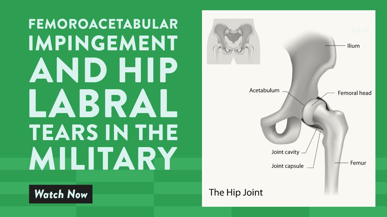 Femoroacetabular impingement and hip labral tears in the military