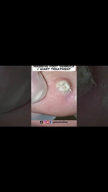 PATIENT MIGHT USING **BAZUKA** MASSIVE FOOT VERRUCA / WART TREATMENT BY PODIATRIST MISS FOOT FIXER