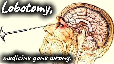 Lobotomy, medicine gone wrong.