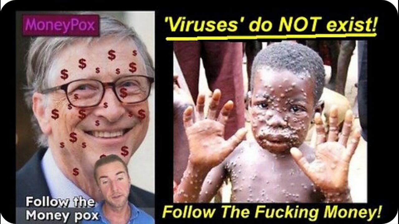 GREED! Follow the Fucking MONKEY-POX aká MONEY-POX 'VIRUS' PLAN-Demic!