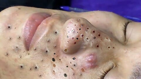 Remove Blackheads and Pimples Popping At HT Spa #29
