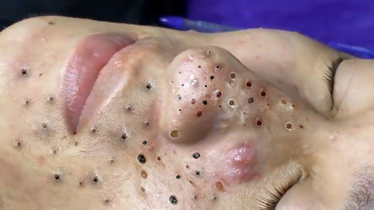 Remove Blackheads and Pimples Popping At HT Spa #29