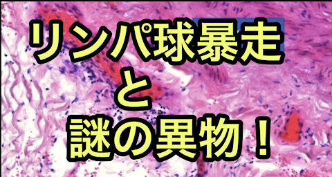 遺体解剖して分かったワクチン接種後のリンパ球暴走、ワクチン液内の得体のしれない異物！