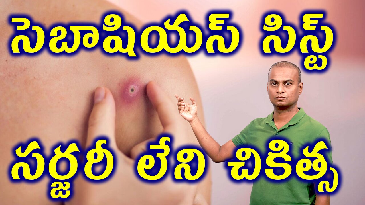 సెబాషియస్ సిస్ట్ కి సర్జరీ లేని చికిత్స Sebaceous cyst Homeopathy Treatment Without Surgery