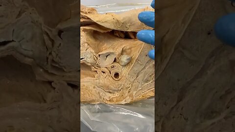 Ectopic Pregnancies 101