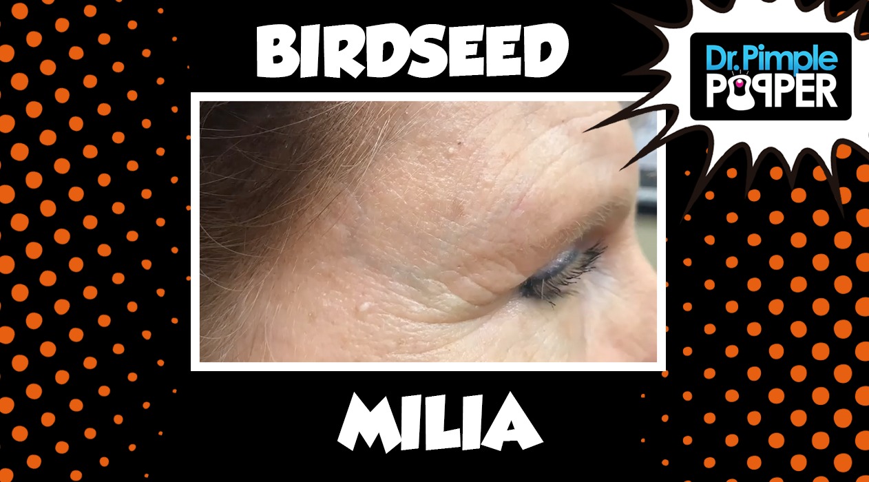 Birdseed Milia