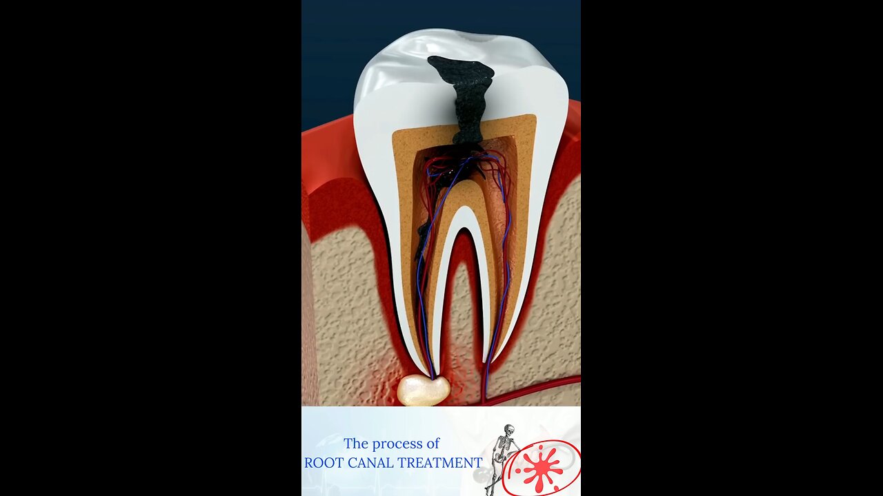 Root_Canal_Treatment_&_Tooth_Abscess