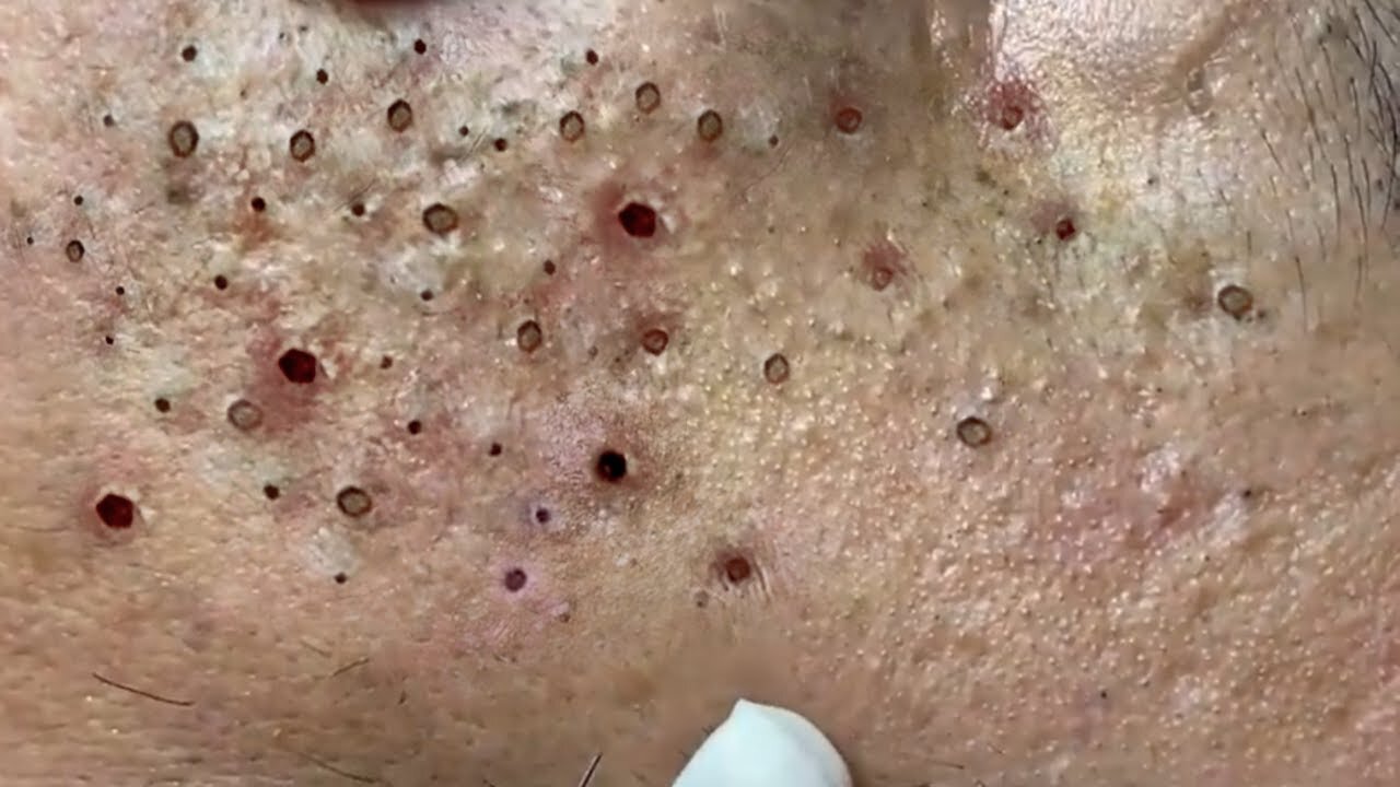 Removing Acne and Blackheads Treatment, #35