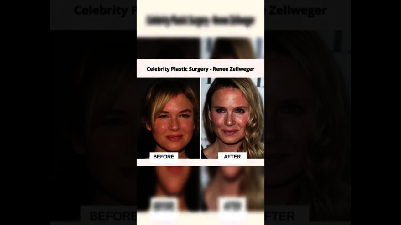 Celebrity Before and After Plastic Surgery