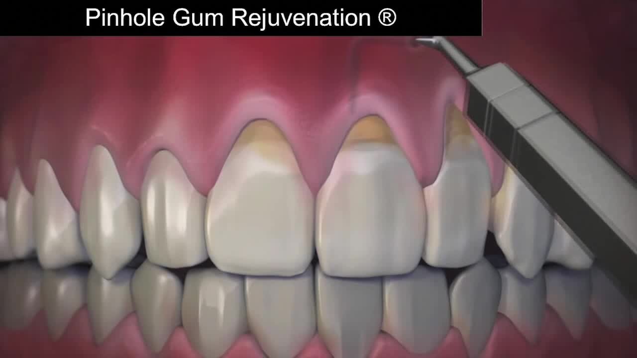 Help for receding gums