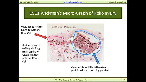 1911 Wickman's Micro-Graph of Polio "Anterior Horn" Vascular Injury - Byron Hyde, MD