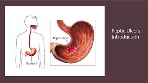 Peptic Ulcers - Introduction