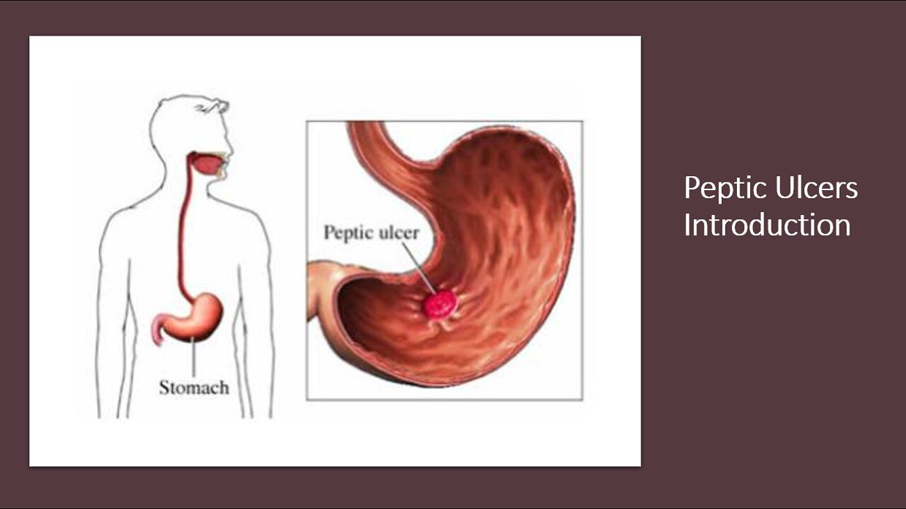 Peptic Ulcers - Introduction