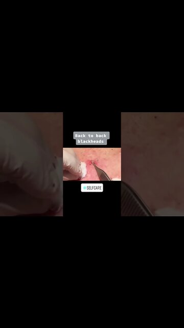 Blackheads Removal on the Back PART 2