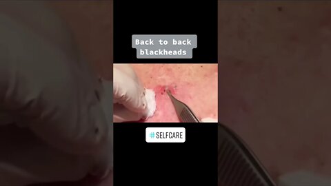 Blackheads Removal on the Back PART 2