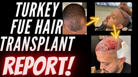 Turkey Hair Transplant Report - IWAM Ep. 560