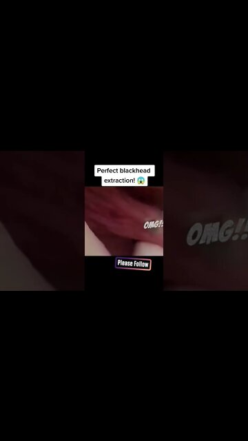 Perfect blackhead extraction!