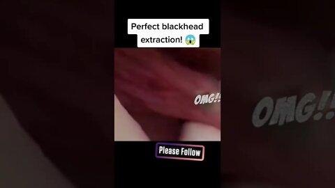Perfect blackhead extraction!