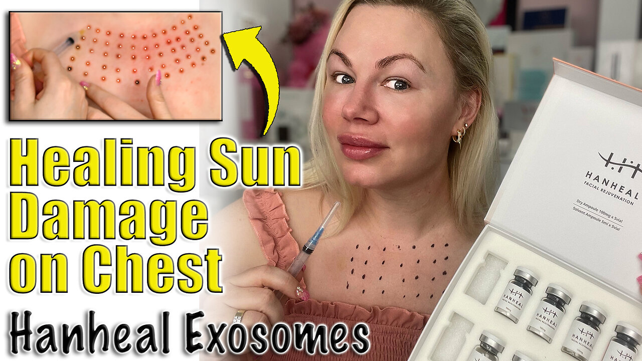 Healing Sun Damage with Exosome Chest Meso Therapy, AceCosm | Code Jessica10 Saves you Money