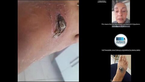 "VACCINE" DAMAGED (BRAZIL) WOMAN REPORTS INJURIES AFTER (2) DOSES OF PFIZER + (1) OF H1N1 (LQC)