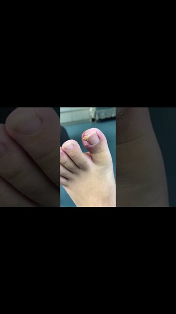 Bloody Ingrown Nail removal
