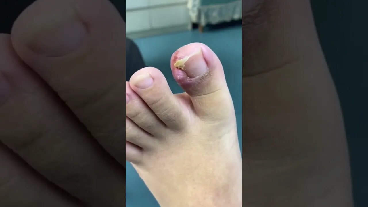 Bloody Ingrown Nail removal