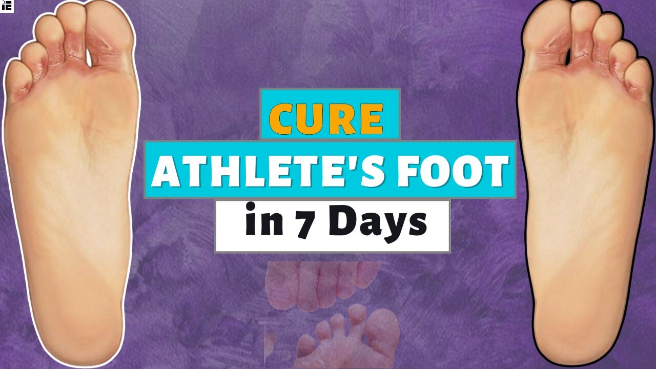 How to Cure Athlete’s foot is SEVEN days