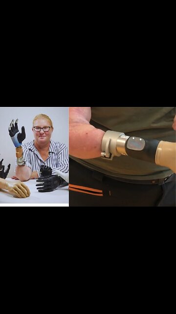 The real bionic woman becomes first human to receive a robotic limb