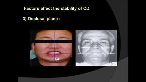 Prosthodontics L8 Part2 (Retention, Stability & Support In Complete Denture)