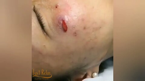 Uma pele carente de cuidados - Remove Squeezing Blackheads and Pimples - Just Relax | Apenas Relaxe