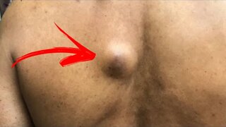 TIRANDO ESPINHA GIGANTE INFLAMADA VIDEO SATISFATORIO espinhas nojentas - inflamed spine