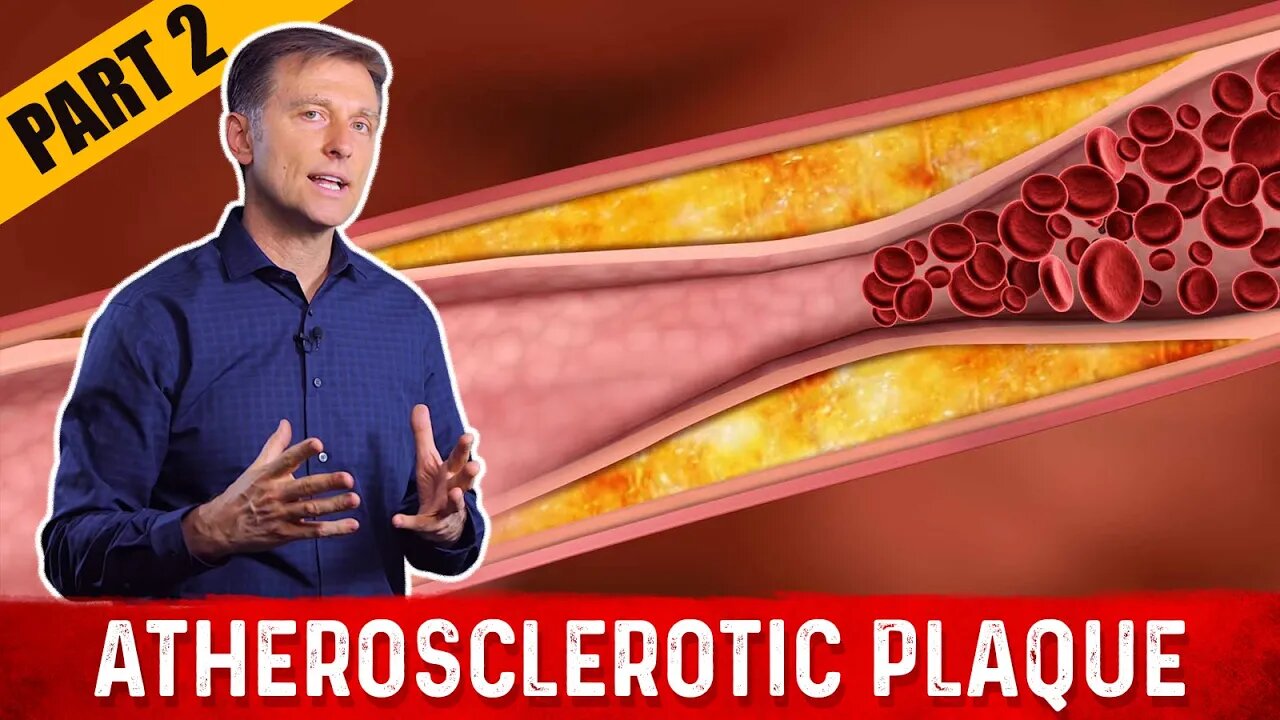 What Is Atherosclerosis Plaque? – Dr.Berg on Cholesterol Levels (Part-2)