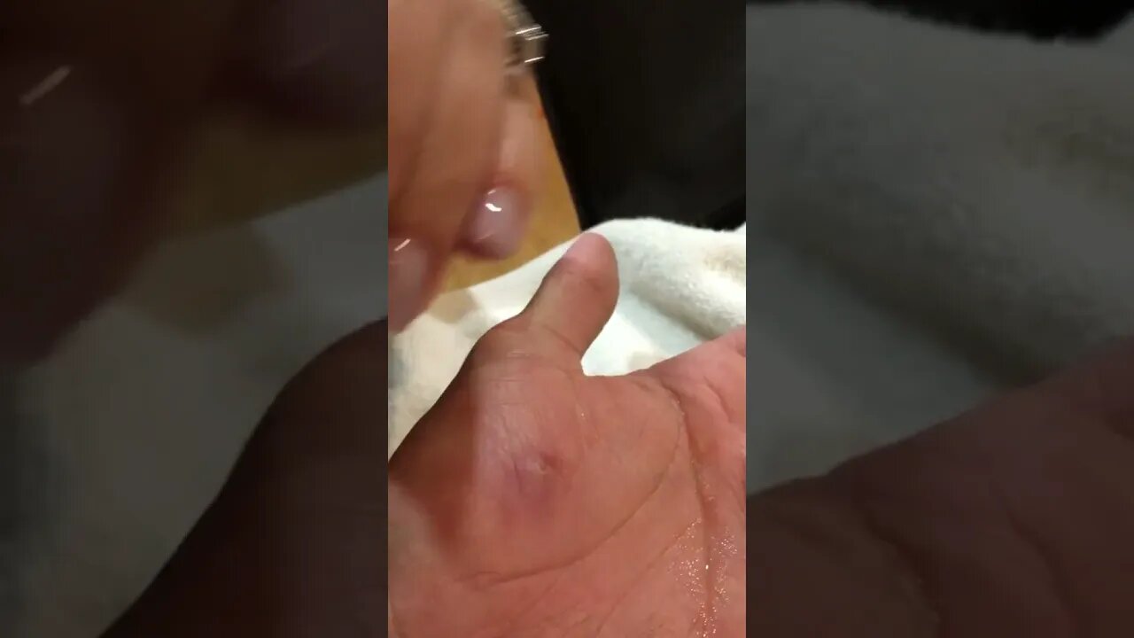 Remoção de Cravos e Espinhas - Remove Squeezing Blackheads and Pimples - Just Relax | Apenas Relaxe