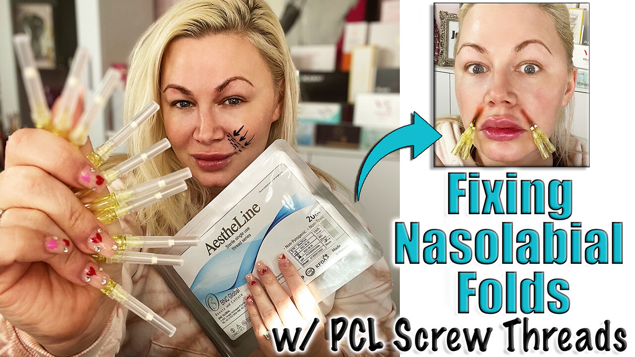 Fixing Nasolabial Folds with PCL Screw Threads from Acecosm.com | Code Jessica10 Saves you Money!