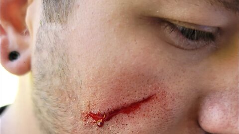 This is Why We Use Eye Protection- My Weedeating Injury