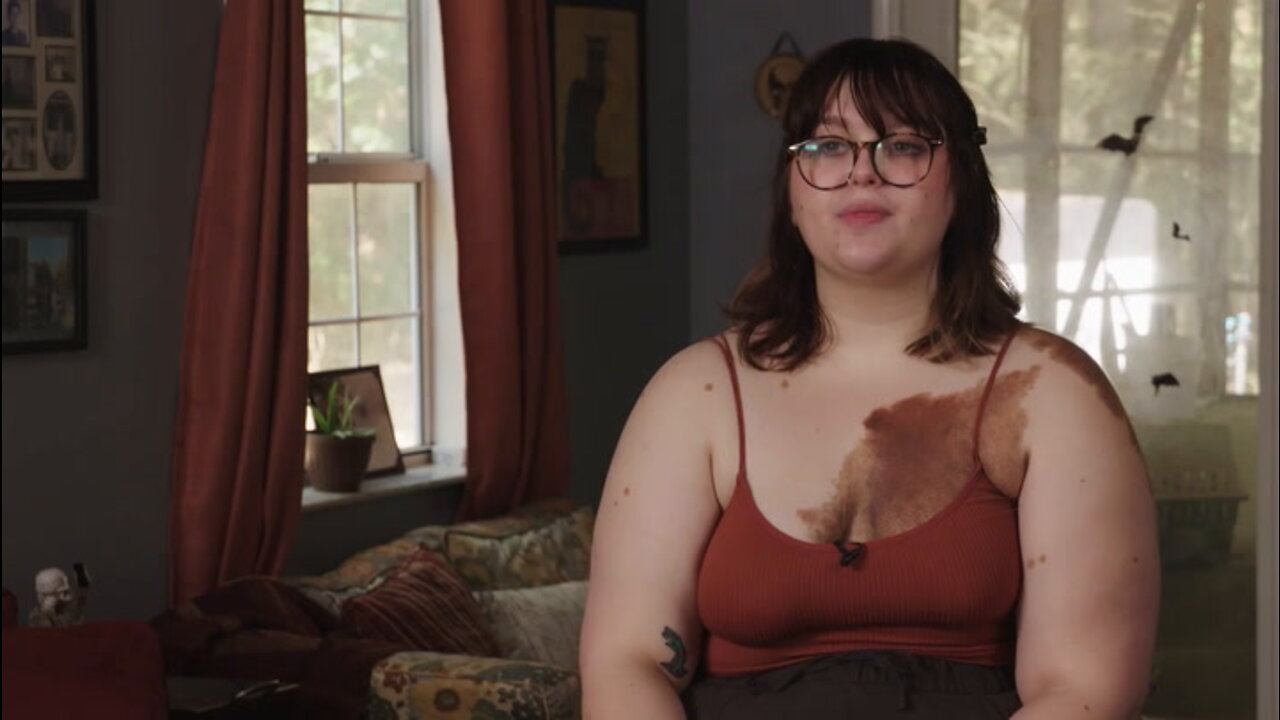 Today I'm Revealing My Giant Birthmark | SHAKE MY BEAUTY